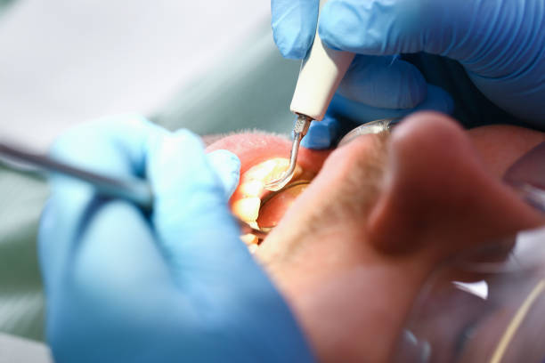 Best Emergency Wisdom Tooth Extraction in Eureka, CA